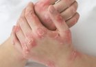 Psoríase ainda é cercada de estigmas e exige diagnóstico precoce, alertam dermatologistas do CEJAM
