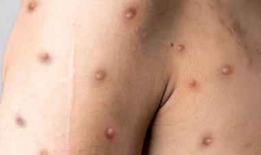 Confirmado primeiro caso de varíola dos macacos no Amazonas