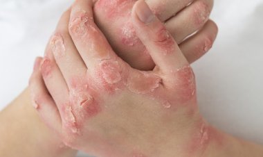 Psoríase ainda é cercada de estigmas e exige diagnóstico precoce, alertam dermatologistas do CEJAM